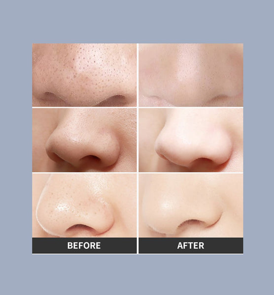 [MPTA00018] MEIPENG Explosions Color Blackhead Remover Electric Pore Cleaner Home Beauty Instrument